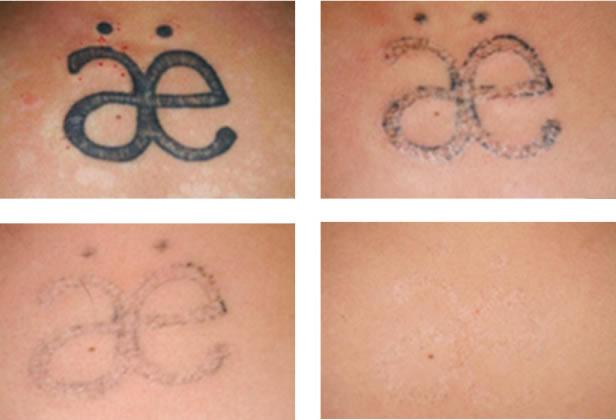 tattoo-removal-healing-process