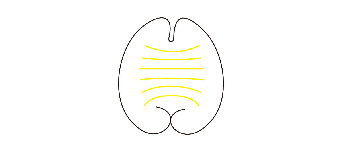 La imagen muestra una representación esquemática del cuerpo calloso, una estructura del cerebro que conecta los hemisferios izquierdo y derecho, facilitando la comunicación entre ellos. Las líneas amarillas representan las fibras que atraviesan el cuerpo calloso, transmitiendo información entre ambas mitades del cerebro para coordinar funciones cognitivas y motoras.